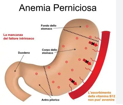 Anemia Perniciosa Sintomi