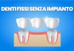 Dentiera Fissa Senza Impianti