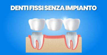 Dentiera Fissa Senza Impianti