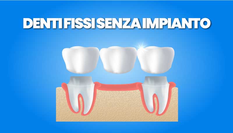 Dentiera Fissa Senza Impianti