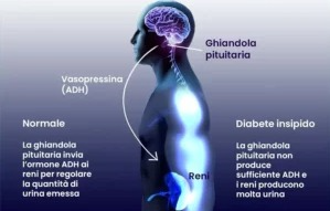 Diabete Insipido Nefrogeno